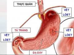 Tìm hiểu về bệnh đau dạ dày