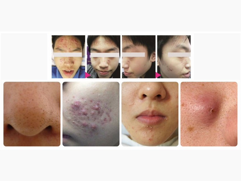 Dấu hiệu mụn trứng cá nặng và nhẹ - nguyên nhân và cách phòng ngừa