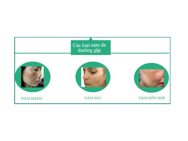 Phân loại nám da, cấp độ nám